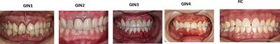 Metabolic Disturbance and Th17/Treg Imbalance Are Associated With Progression of <mark class="highlighted">Gingivitis</mark>